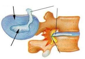 Destruição do anel fibroso com osteocondrose cervical