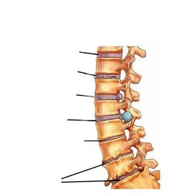 Estágios de desenvolvimento de osteocondrose