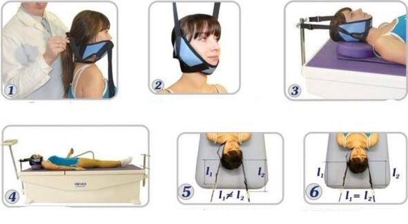 Tratamento da osteocondrose cervical com eliminação