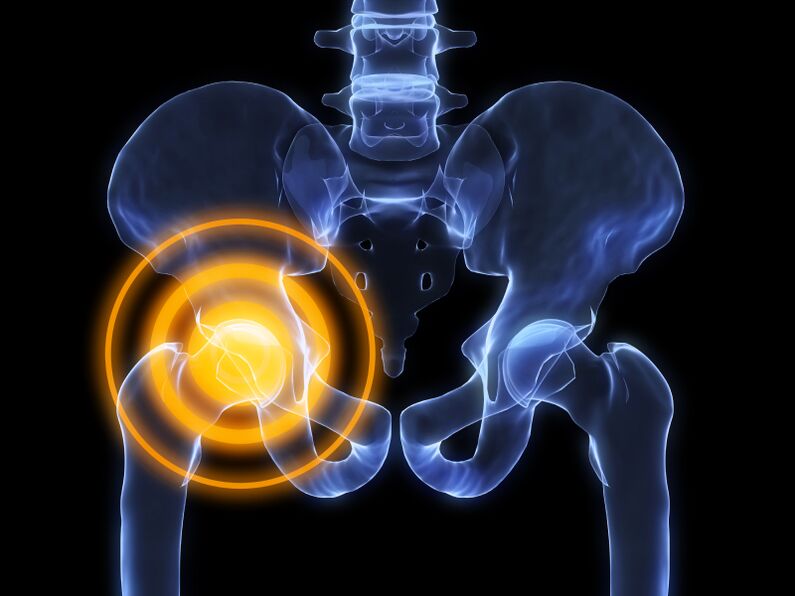 artrose da articulação do quadril